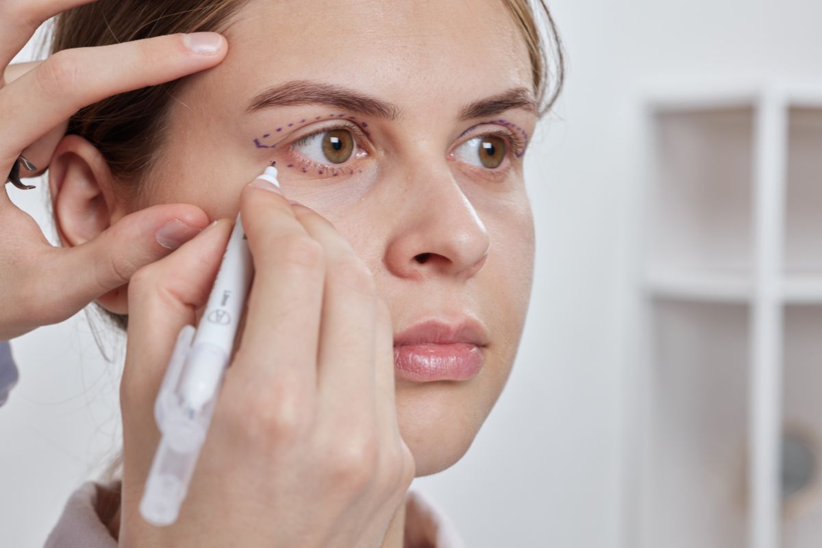 Blefaroplastia