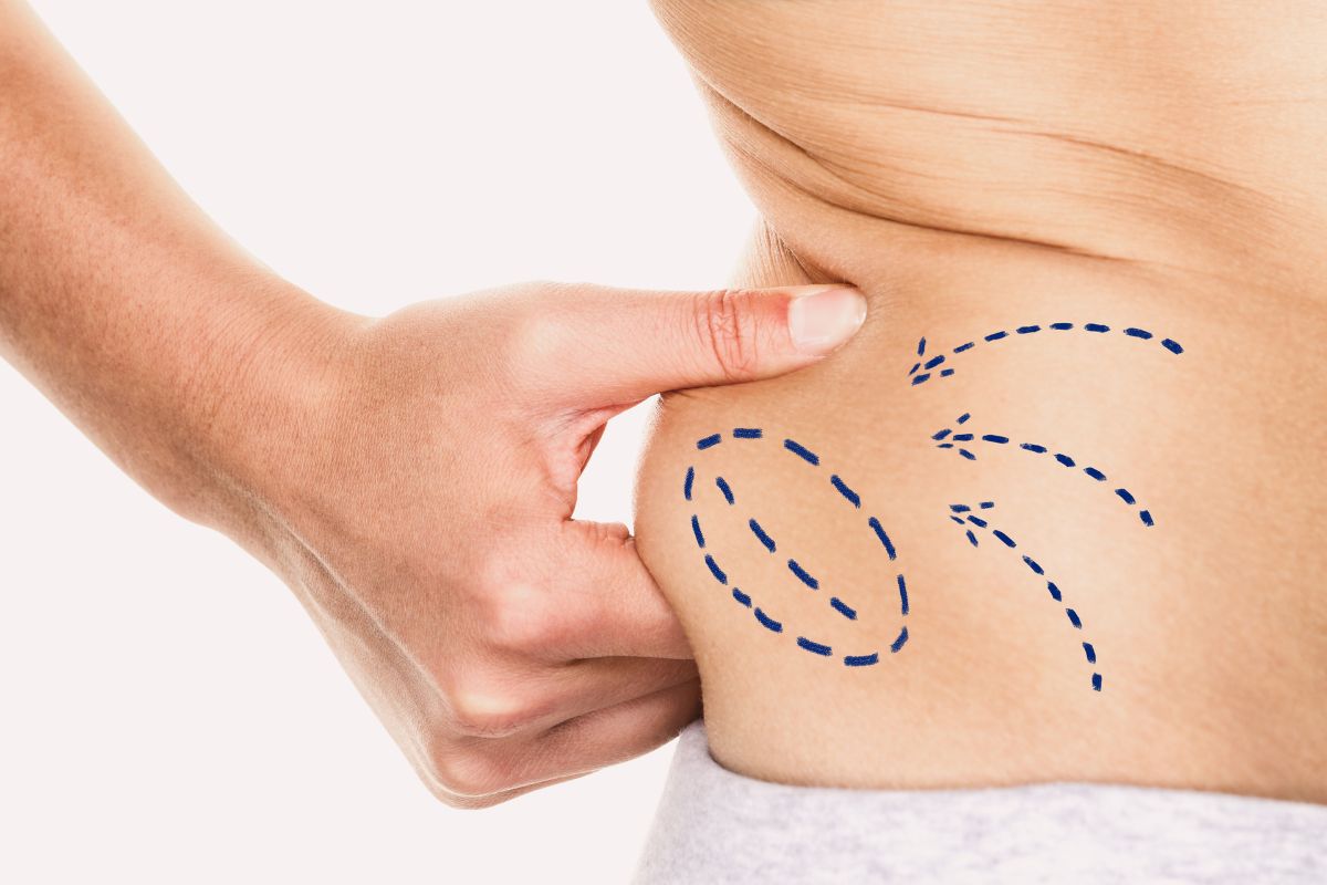 Intralipoterapia